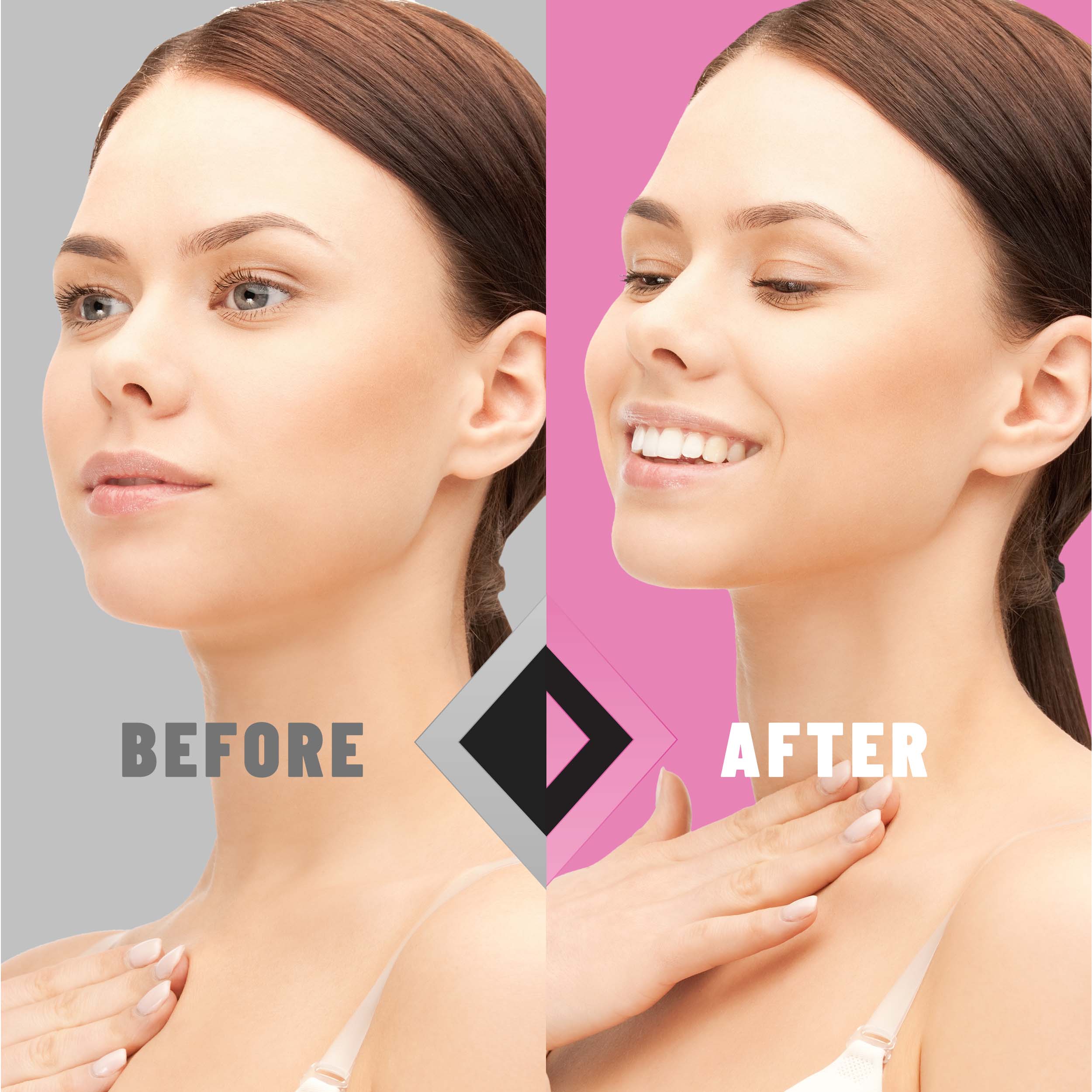 V-Line Lifting Mask, Double Chin Reducer with Hydrogel & Vitamin E, 5 masks