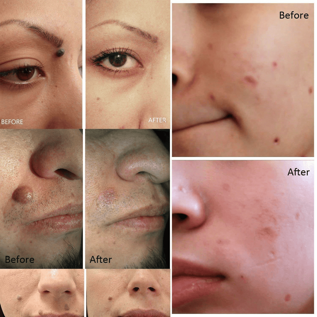 Electric Laser Plasma Pen — Mole, Wart & Dark Spot Removal Device