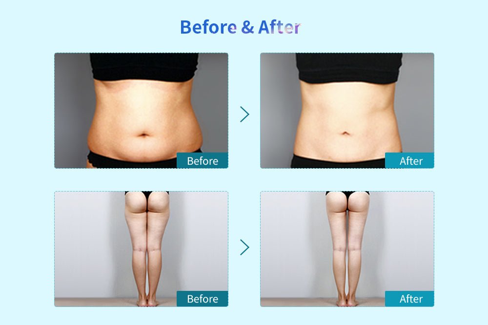 Shape Tactics Cryolipolysis Cold Vacuum Body Contouring System — Bilingual Display