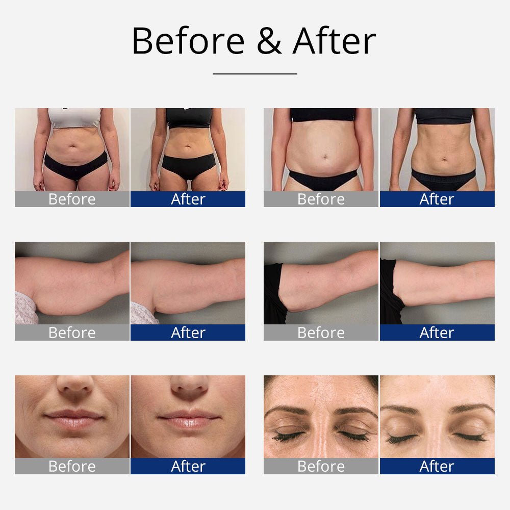 Shape Tactics 4-in-1 40K Unoisetion Cavitation RF & EMS Body Sculpting System