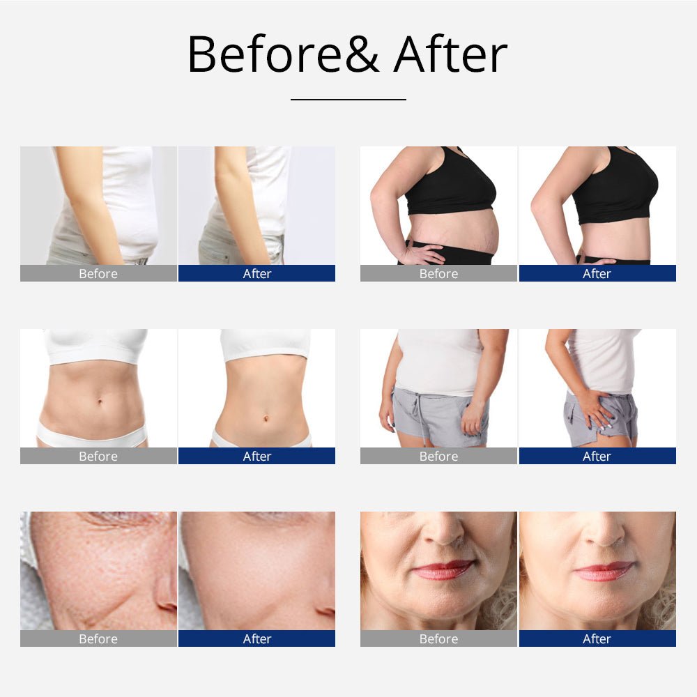 Shape Tactics 5-in-1 Unoisetion Cavitation 2.0 & 3D SMART RF Body Contouring System