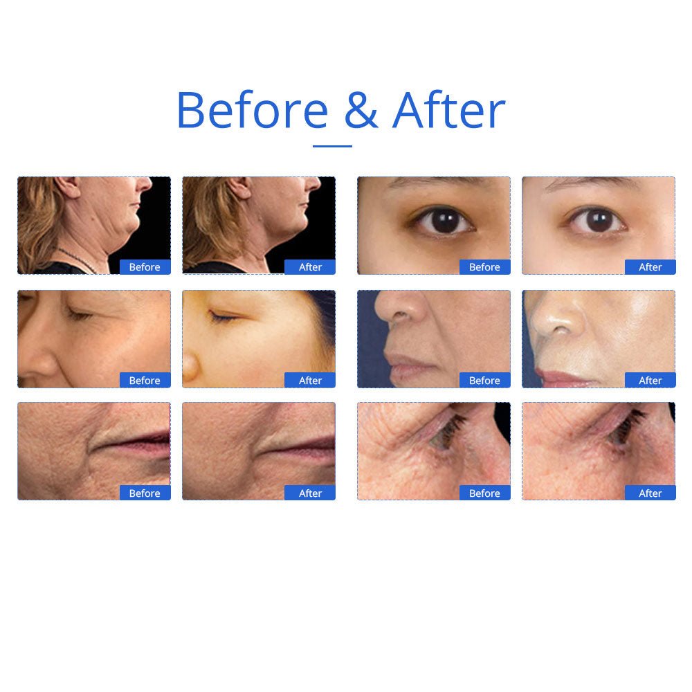 Shape Tactics 5-in-1 Unoisetion Cavitation & SMART 3D RF Body Contouring System