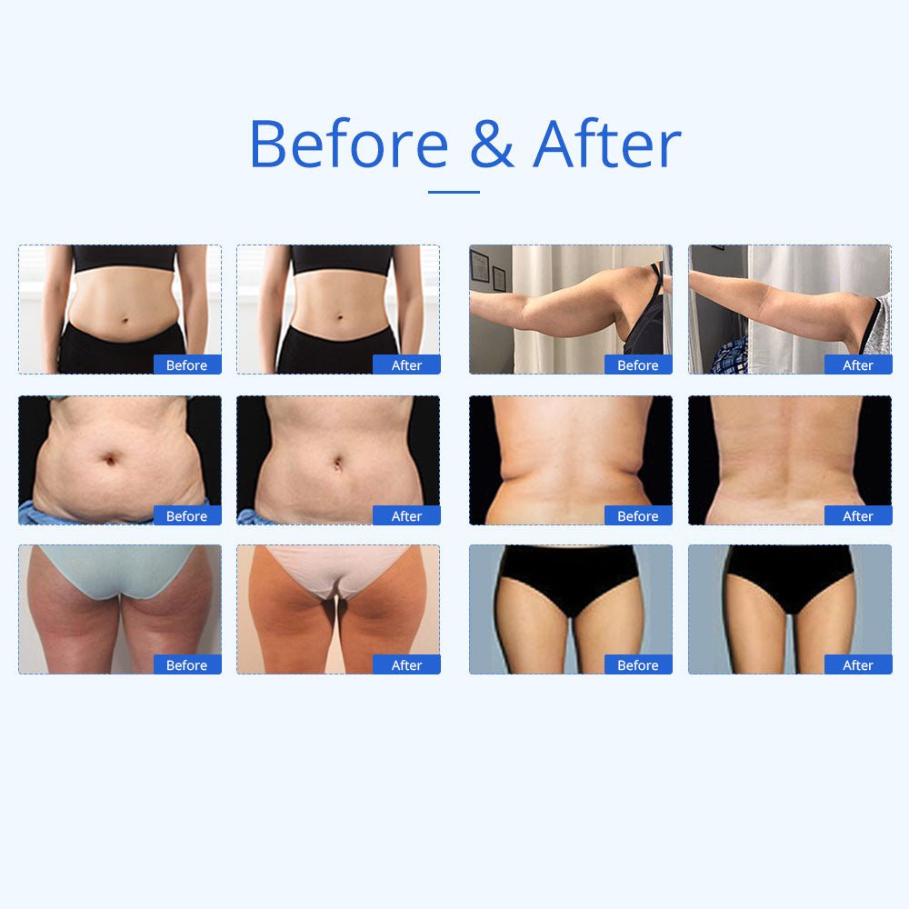 Shape Tactics 5-in-1 Unoisetion Cavitation & SMART 3D RF Body Contouring System