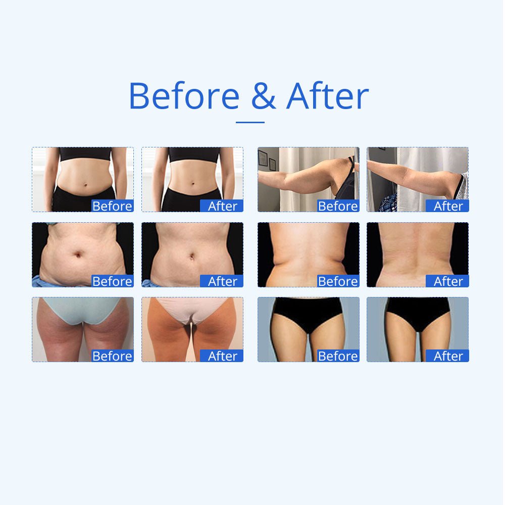 Shape Tactics 5-in-1 Unoisetion 40K Cavitation & Multi-Polar RF Body Contouring System