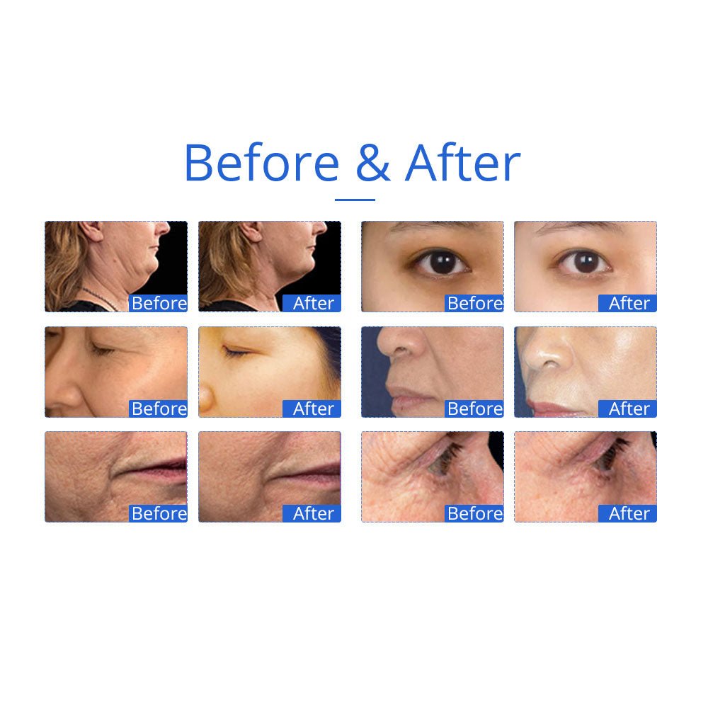 Shape Tactics 5-in-1 Unoisetion 40K Cavitation & Multi-Polar RF Body Contouring System