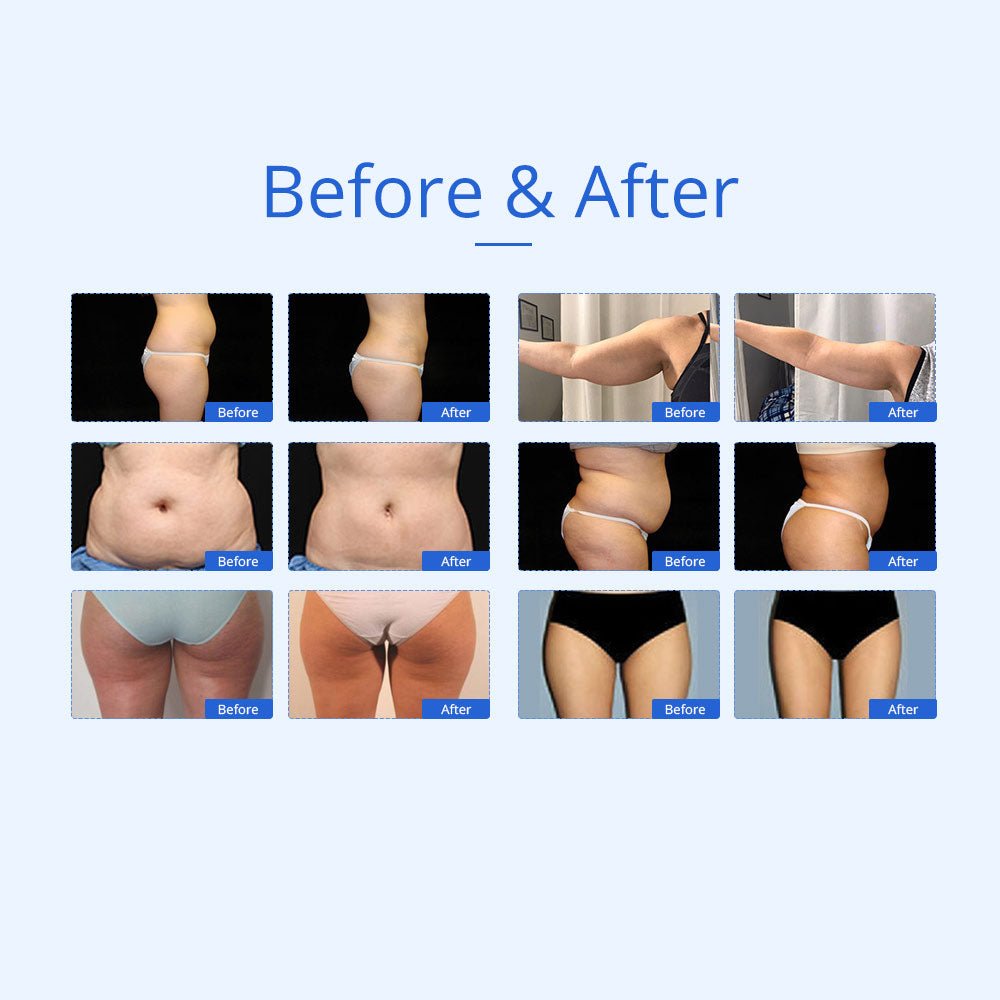 Shape Tactics 7-in-1 40K Cavitation Multi-Polar RF BIO Lift & Hot-Cold Therapy System