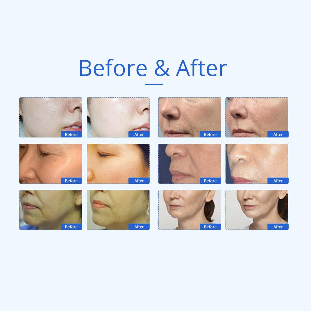 Shape Tactics 7-in-1 40K Cavitation Multi-Polar RF BIO Lift & Hot-Cold Therapy System