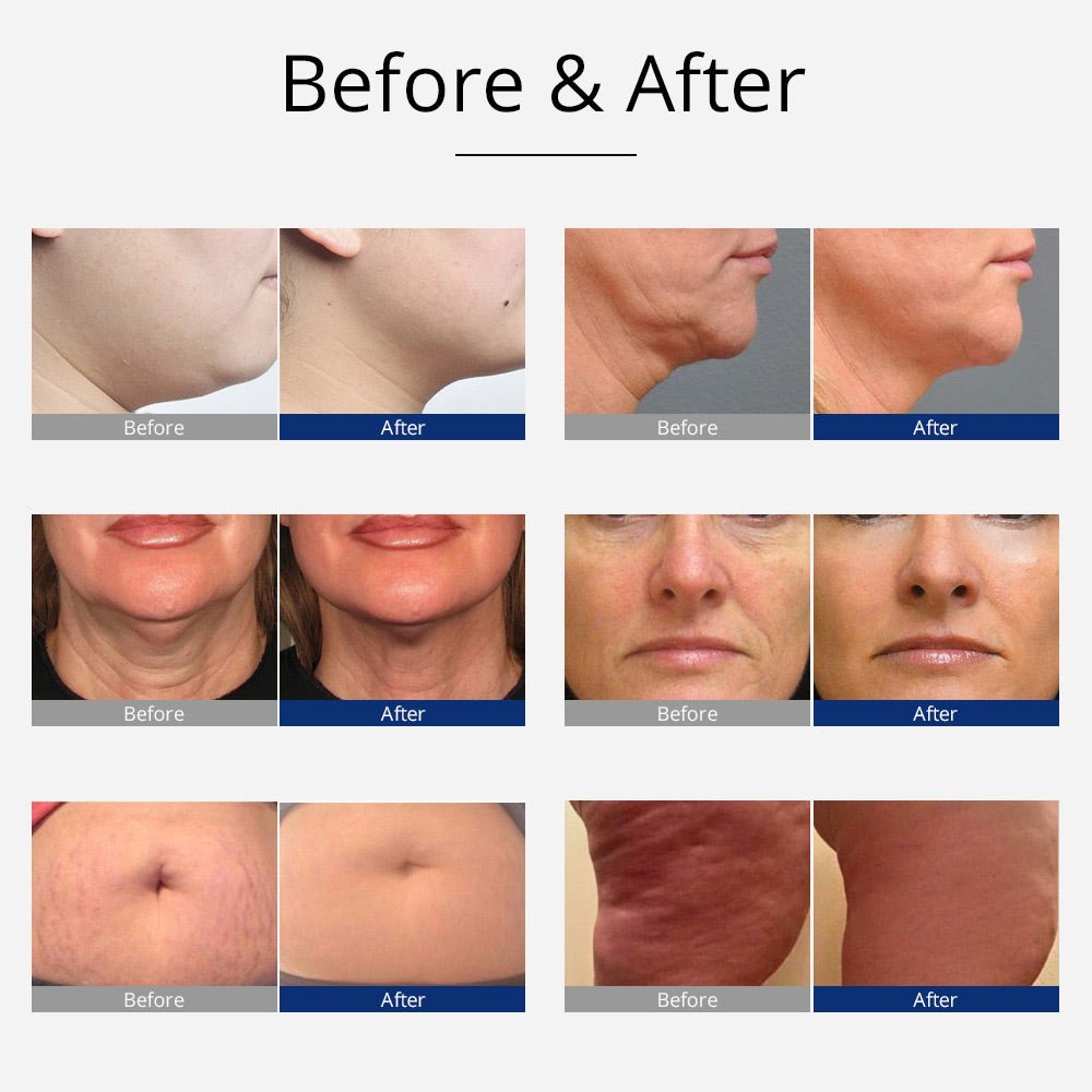 Shape Tactics 8-in-1 Unoisetion Cavitation RF Bio Microcurrent & Hot/Cold Therapy System