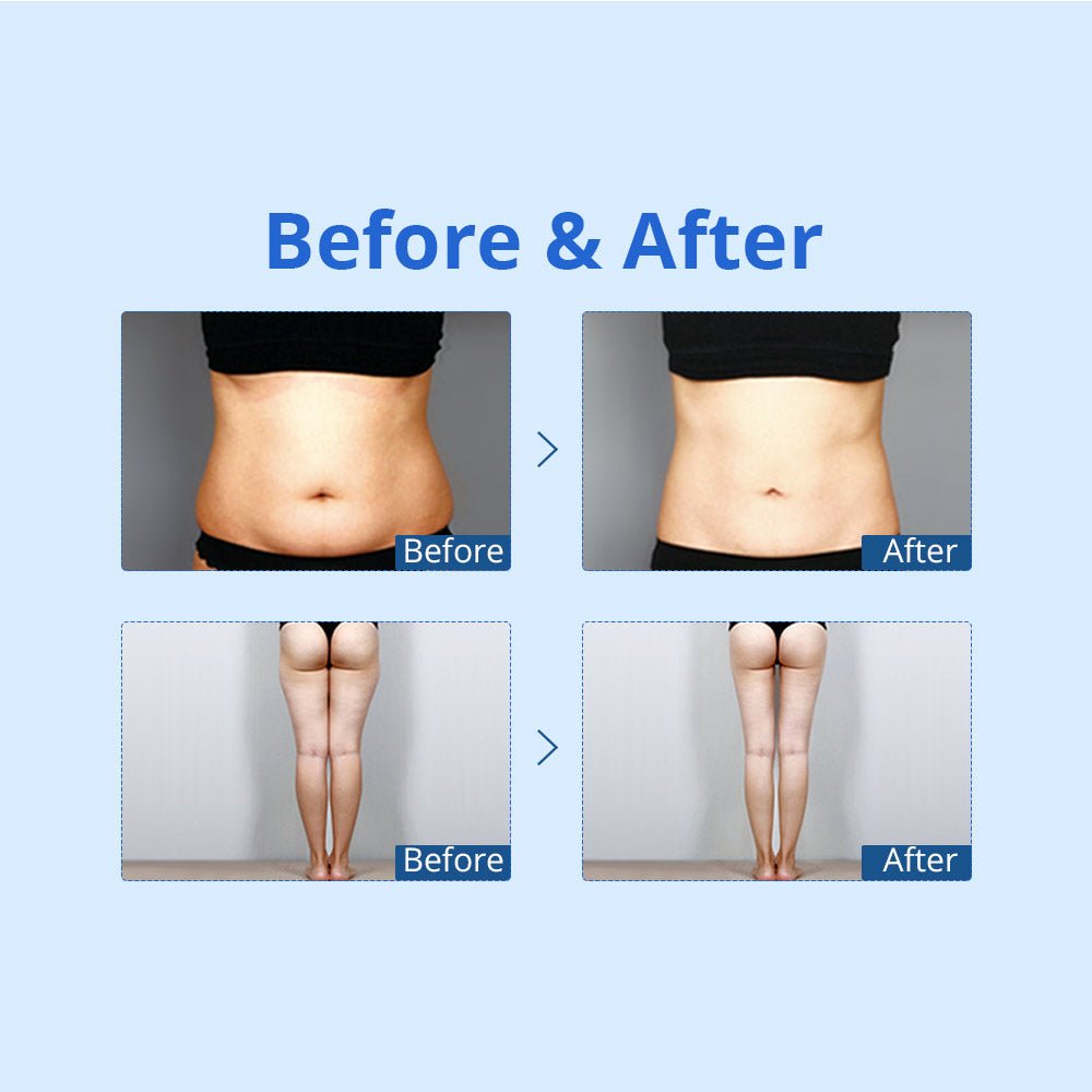 Shape Tactics Cryolipolysis Cold Vacuum Body Contouring System