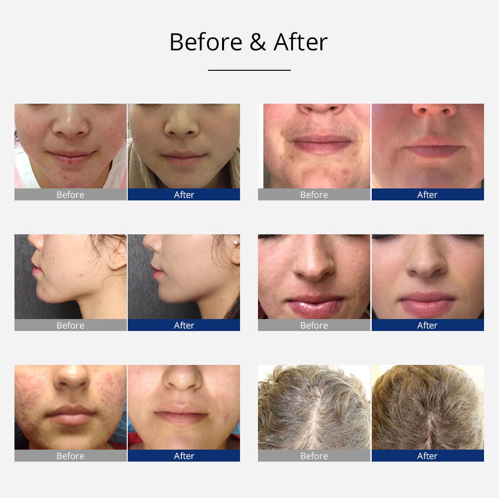 Shape Tactics Portable High-Frequency Facial & Scalp Therapy Wand — Neon & Argon