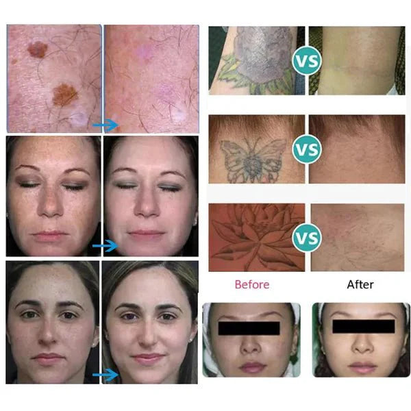 Shape Tactics Advanced 4-Wavelength Picosecond Laser System