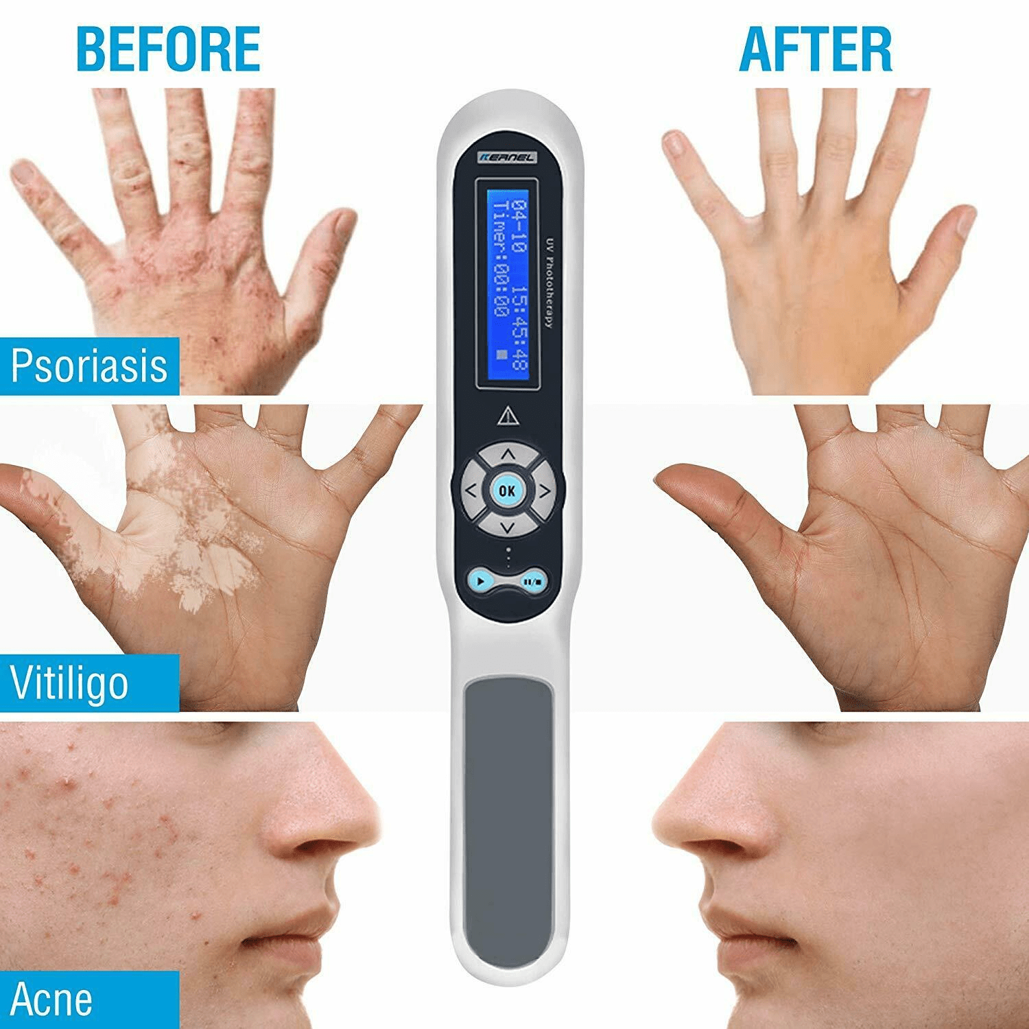 Shape Tactics UVB 311nm Phototherapy Device