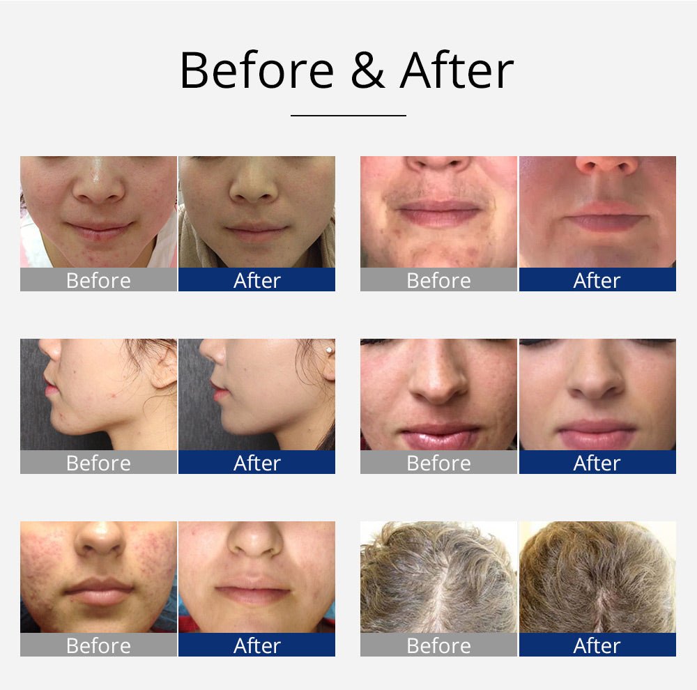 Shape Tactics 7-Electrode High-Frequency Facial & Scalp Therapy System