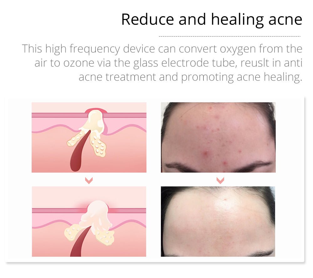 Shape Tactics 7-Electrode High-Frequency Facial & Scalp Therapy System